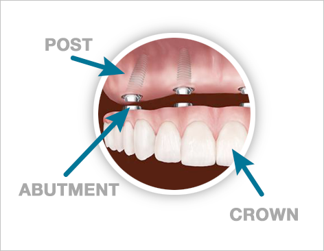 All-On-4 Implants - Post - Abutment - Crown