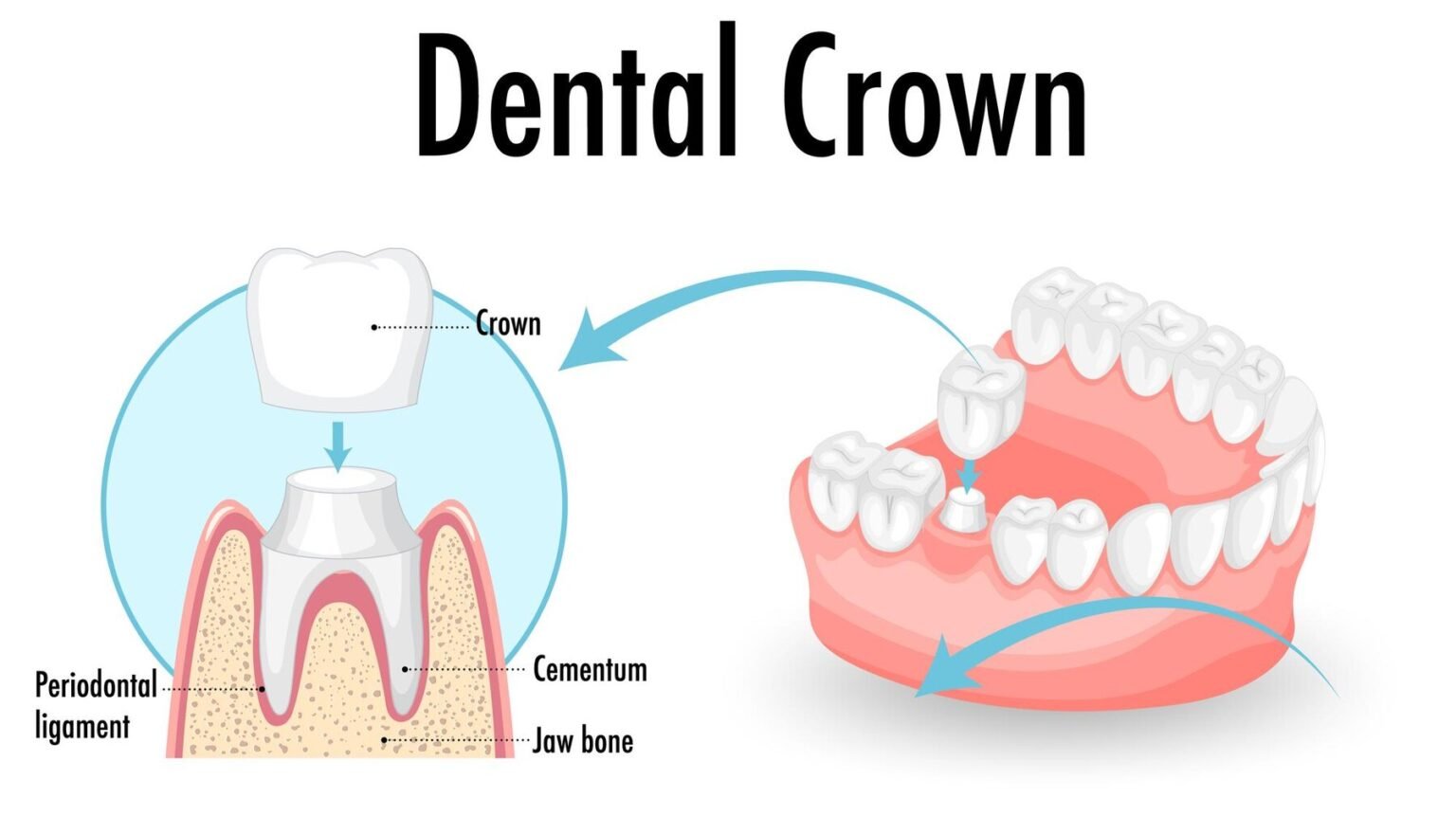 Dental Crowns in Costa Rica, Procedures and Prices | Colina Dental